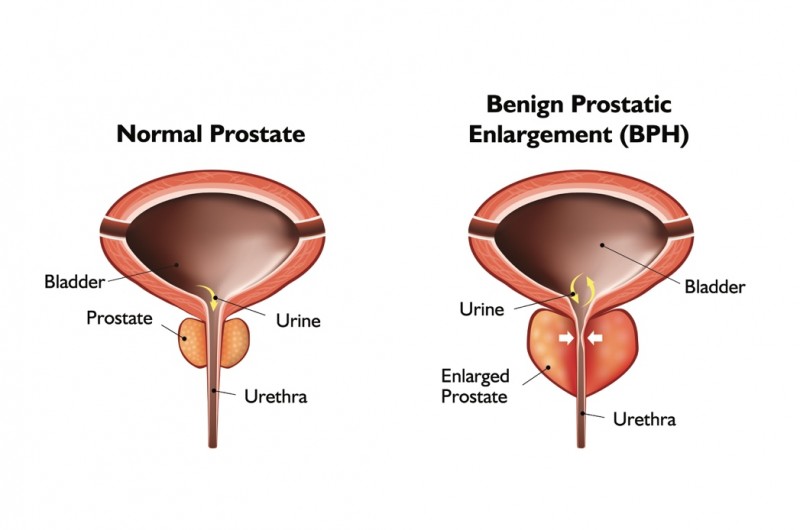 normal prostate vs protate with BPH