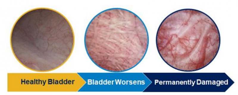 Bladder and Enlarged Prostate